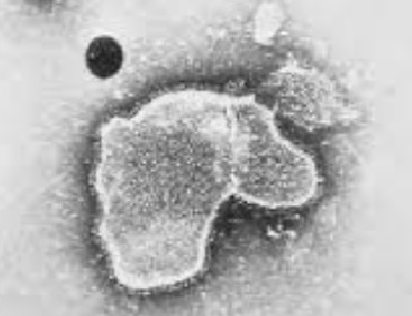El virus respiratorio sincitial puede causar infecciones graves (bronquiolitis y neumonías), especialmente en niñas y niños pequeños.